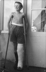 Long shot of a child standing outside a ward with crutches full plaster cast on leg wearing sunglasses posing for the camera. On Crutches, Circa 1955