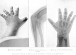 Achondroplasia Article, 1902